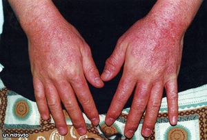 Медицинское описание возможных заболеваний кожного покрова рук