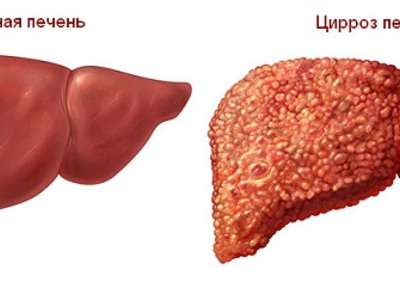 Фиброз печени 4 степени фото