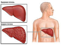 Болезнь гепатит С