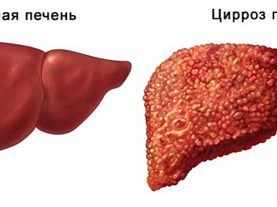 Признаки болезни печени у мужчин фото