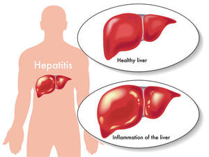 Симптоматика вируса гепатит