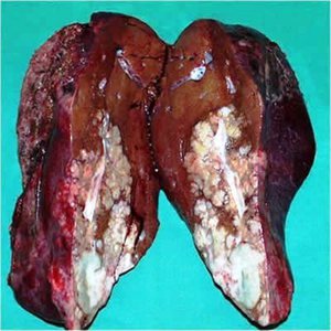 Печени пораженная раком - внешний вид органа.